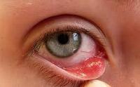 Mẹo đơn giản ngừa đau mắt đỏ mùa hè