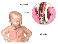 Ðể dị tật tiêu hóa không đe dọa sự sống của trẻ