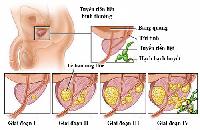 Cách dự phòng tăng sinh tiền liệt tuyến lành tính