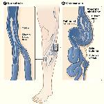 Cách chữa bệnh về tĩnh mạch ít đau, không sẹo