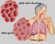 8 dấu hiệu của bệnh viêm phổi bạn không nên bỏ qua