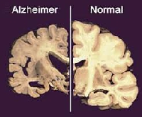 Tìm ra hóa chất có tác dụng giảm bệnh Alzheimer