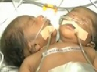 Bé trai 2 đầu chào đời tại Ấn Độ