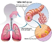 Nắng nóng - Làm gì để không mắc bệnh?