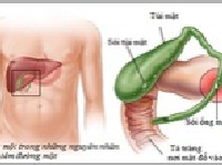 Nhận biết nhiễm khuẩn đường mật