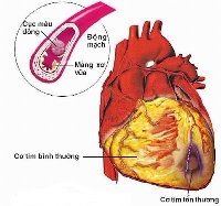 Phòng ngừa bệnh động mạch vành