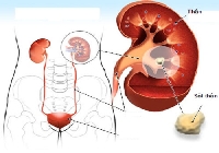 Tất cả những điều bạn cần biết về bệnh sỏi thận