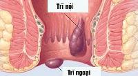 Bệnh trĩ, không nên tự chữa!