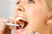 Cao răng - Thủ phạm gây bệnh nha chu