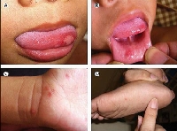 Trẻ bị tái nhiễm bệnh tay chân miệng có nguy hiểm?