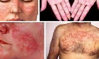 Bệnh lupus ban đỏ nguy hiểm hơn bạn nghĩ
