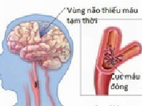 Để giảm biến chứng thiểu năng tuần hoàn não