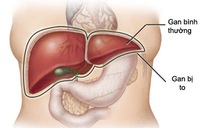 Những dấu hiệu chứng tỏ bạn bị tổn thương gan