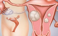 Những dấu hiệu của bệnh u xơ tử cung