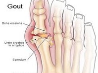 Nỗi ám ảnh mang tên "bệnh gút"