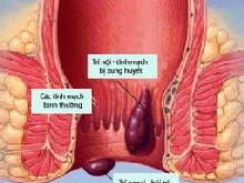 Liệu pháp tối ưu với người bệnh trĩ