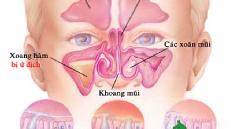 Để an toàn khi điều trị viêm xoang