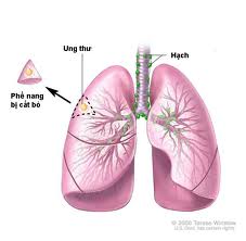 Thuốc mới điều trị ung thư phổi tế bào nhỏ di căn