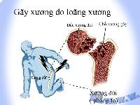 Vitamin E có thể gây ung thư tuyến tiền liệt, loãng xương?