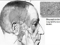 Cách nhận biết viêm động mạch khu trú thái dương