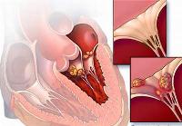 Viêm cơ tim cấp: Bệnh nặng, khó chẩn đoán